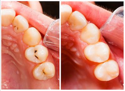 filling-before-and-after.jpg